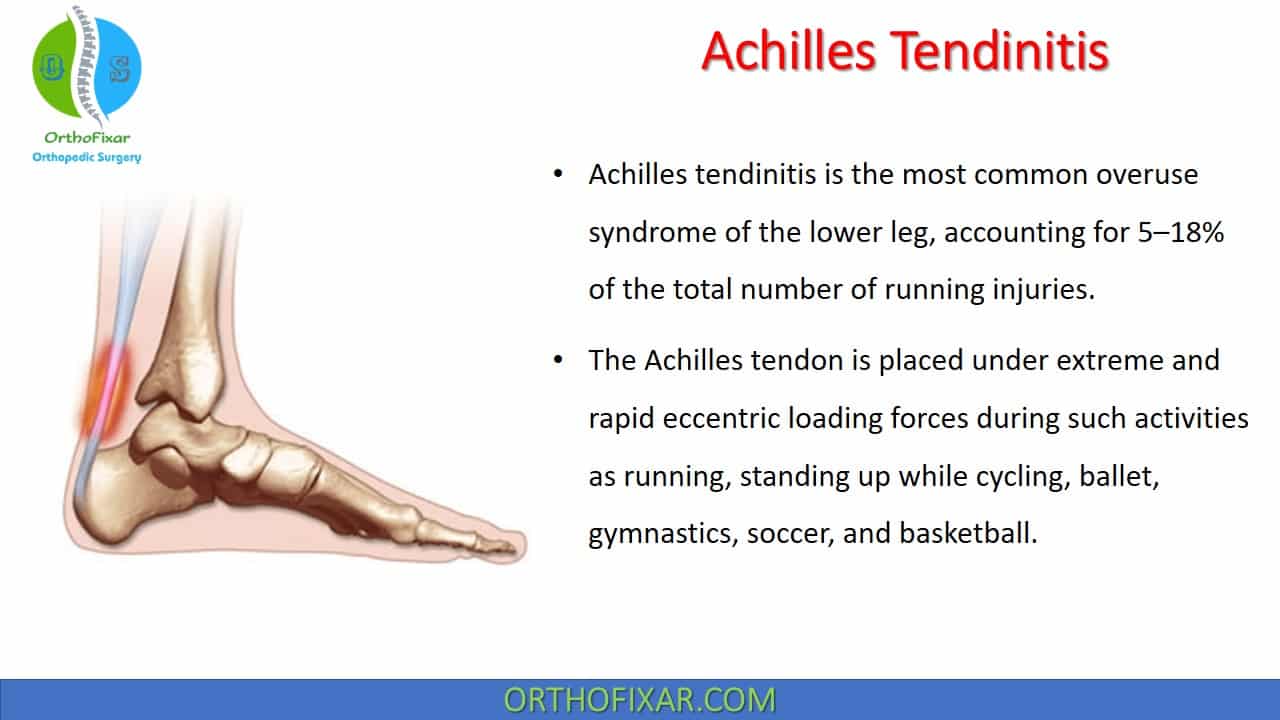  Achilles Tendinitis 