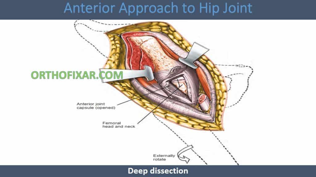 Anterior Approach to Hip - Smith-Petersen approach Joint