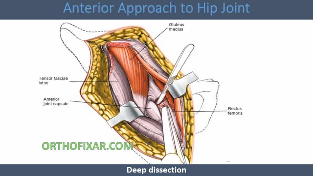 Anterior Approach to Hip Joint