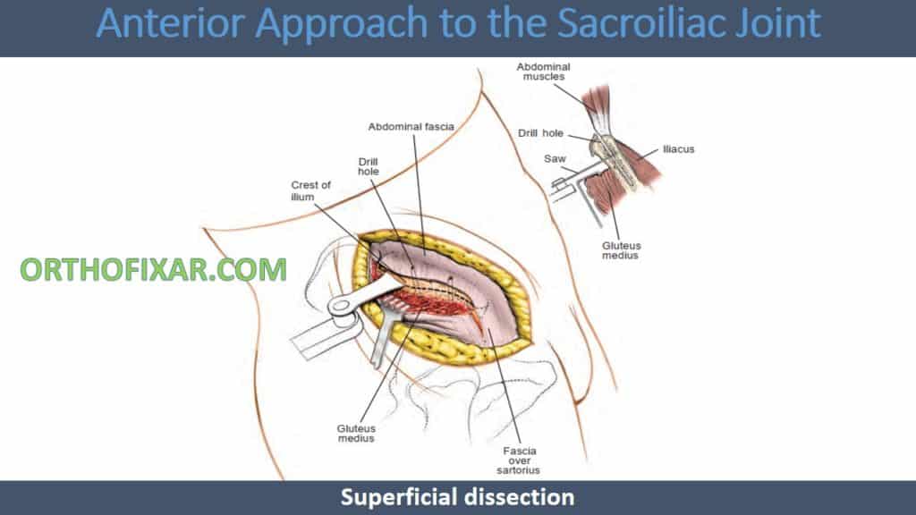 Anterior Approach to Sacroiliac Joint