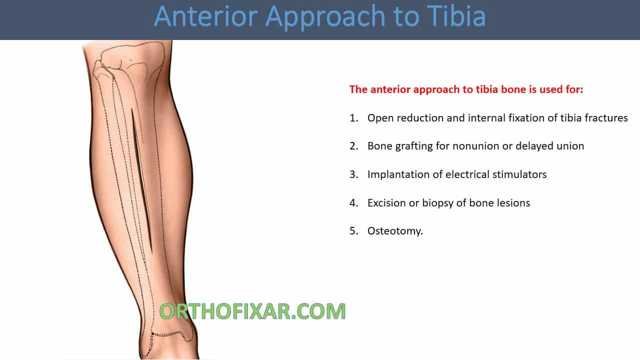  Anterior Approach to Tibia 