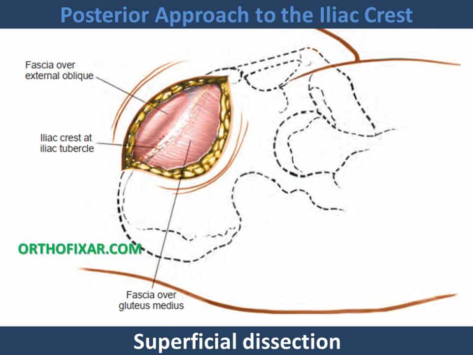 Anterior Approach to the Iliac Crest