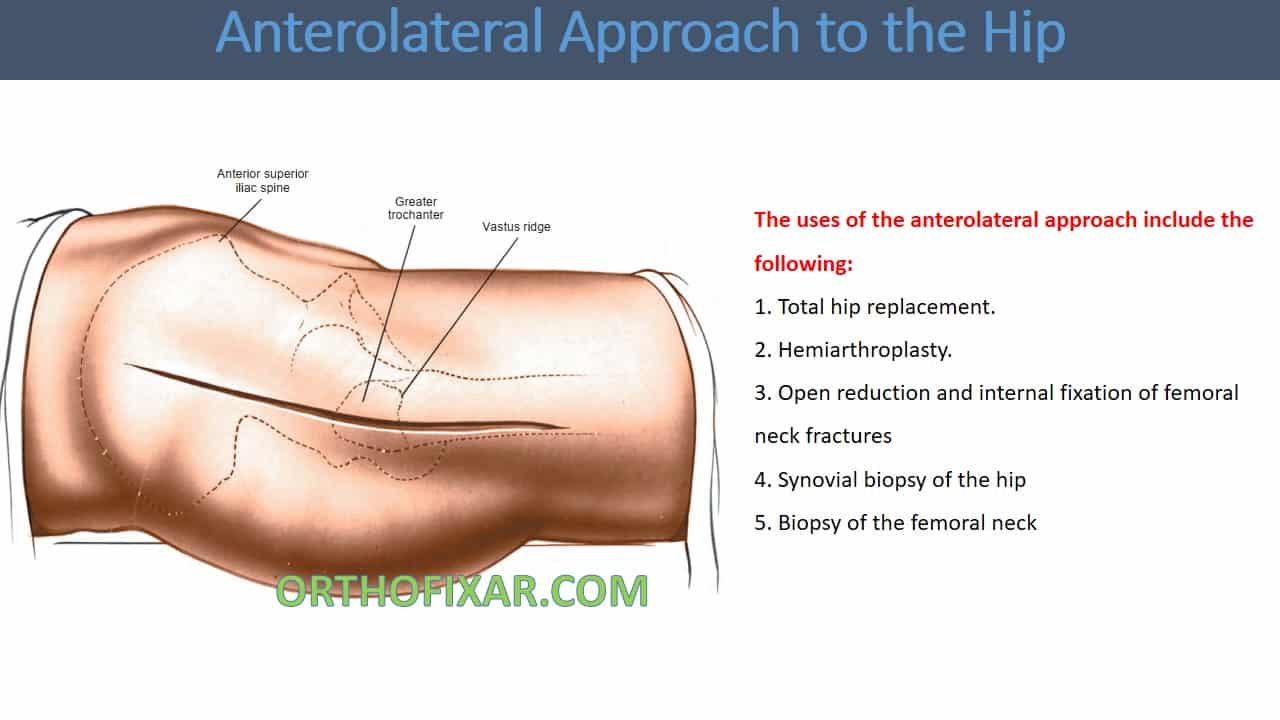  Anterolateral Approach to Hip Joint 