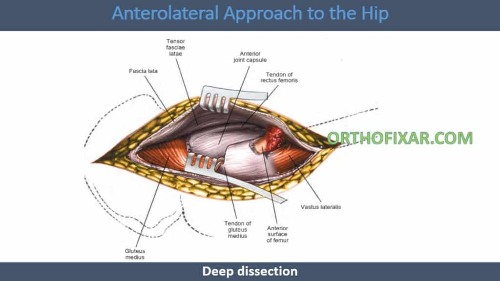 Anterolateral Approach to the Hip