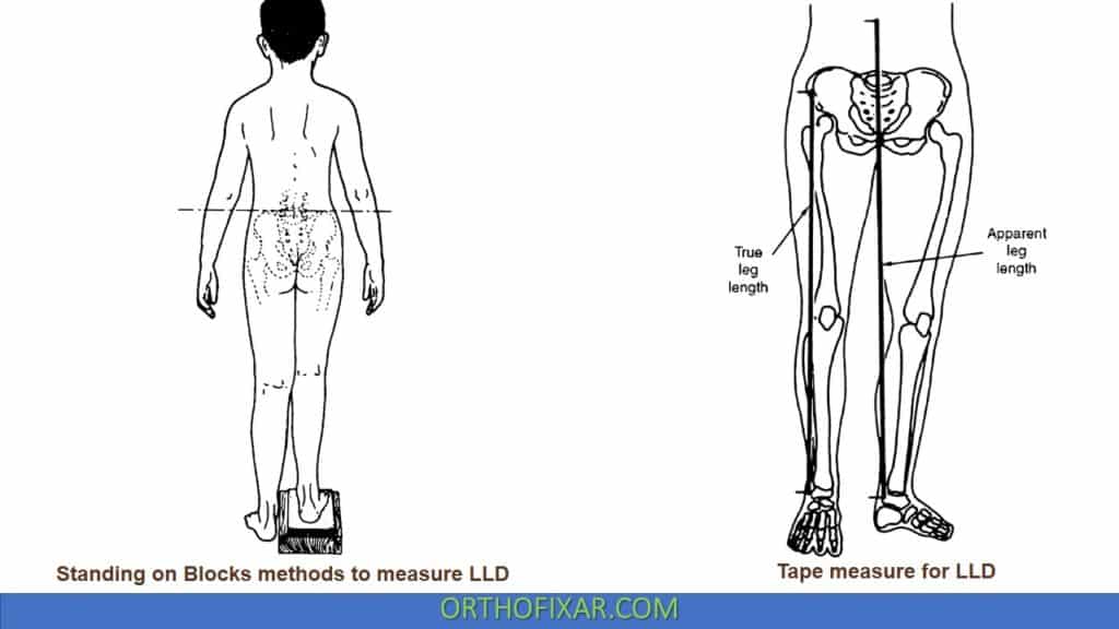 Assessing Leg length Difference LLD