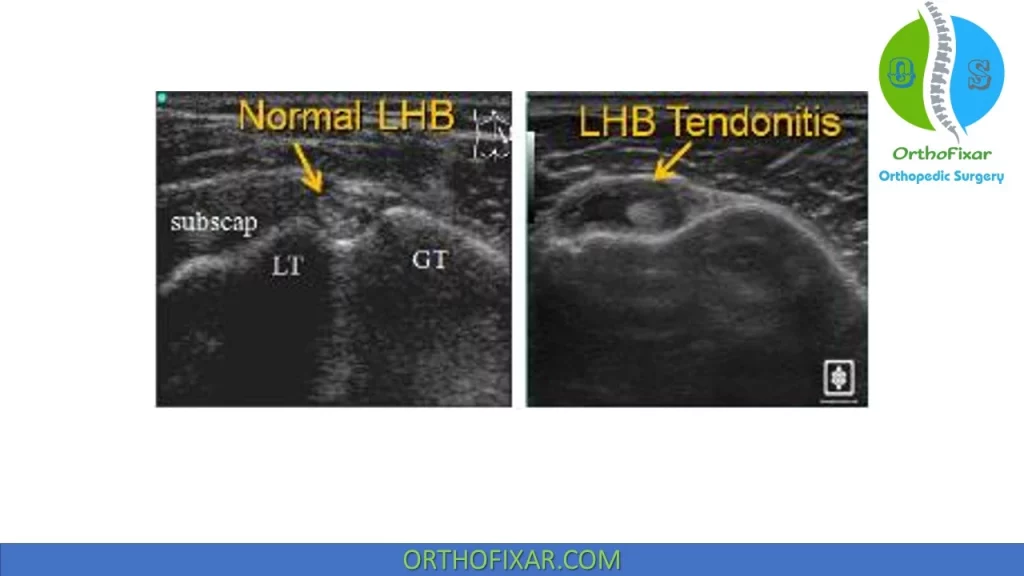 Biceps Tendonitis Ultrasound