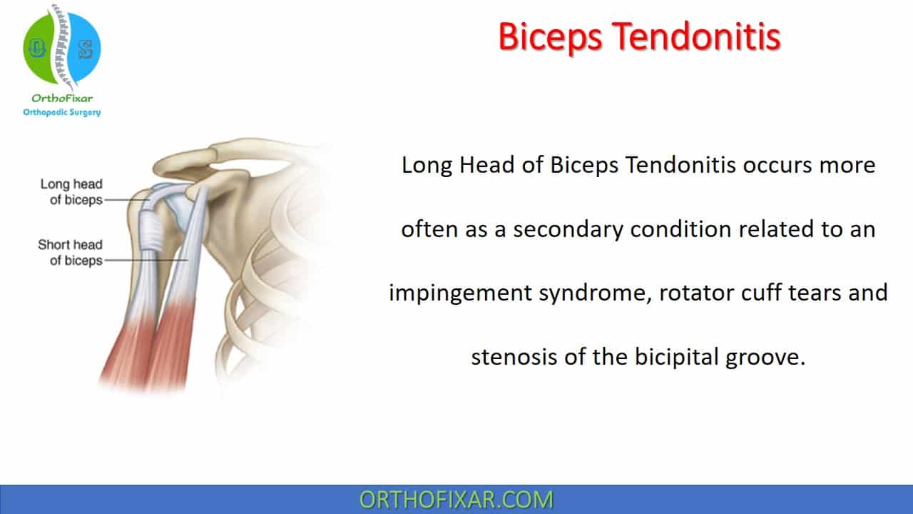  Biceps Tendonitis 