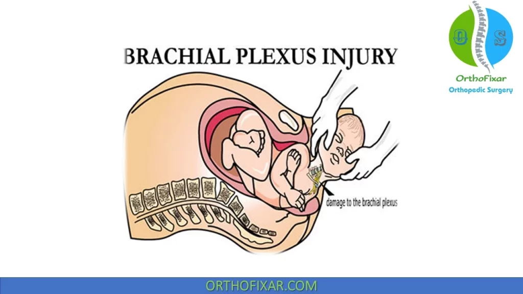 Brachial Plexus Palsy causes