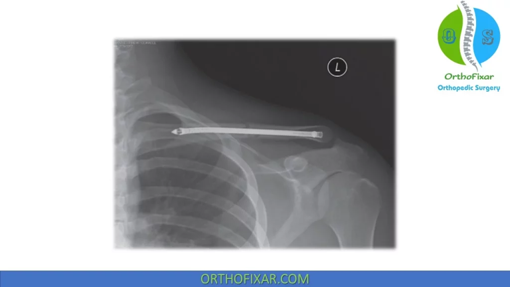 Clavicle Fractures with intramedullary fixation
