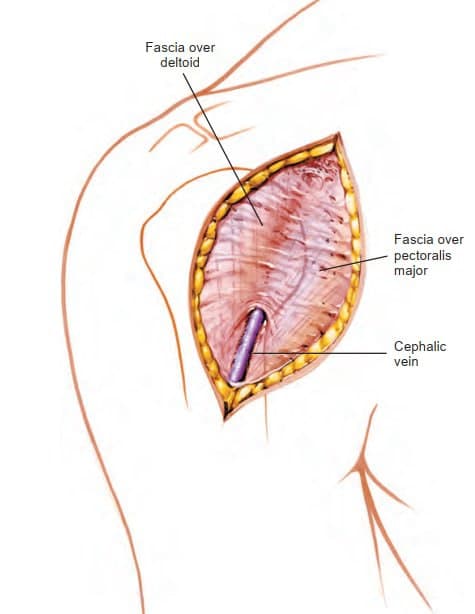 Deltopectoral Approach to the Shoulder