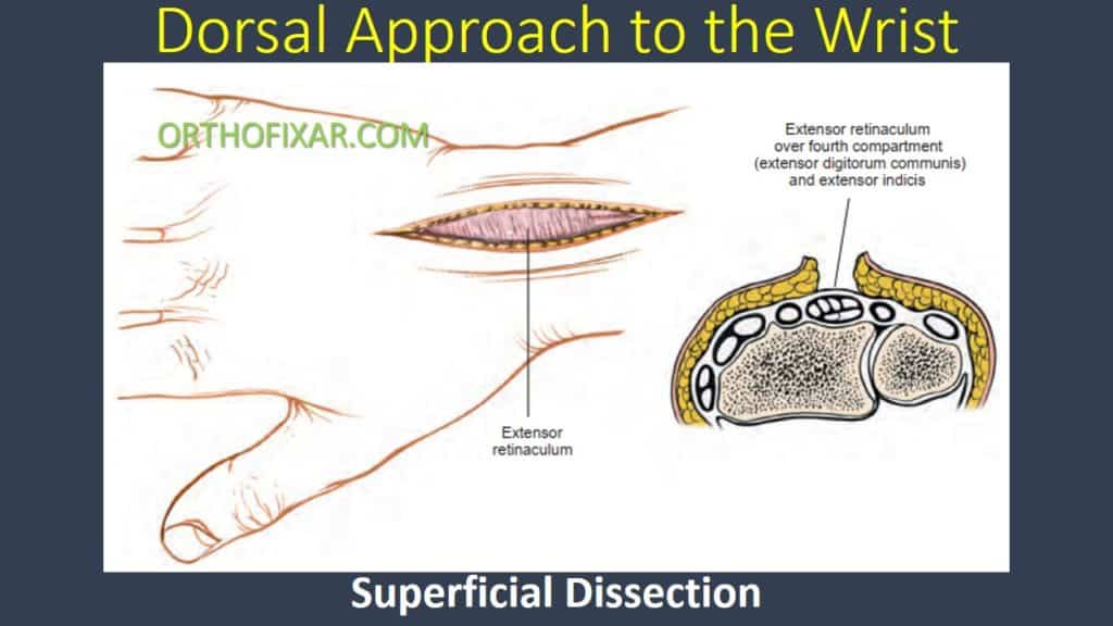 Dorsal Approach to the Wrist