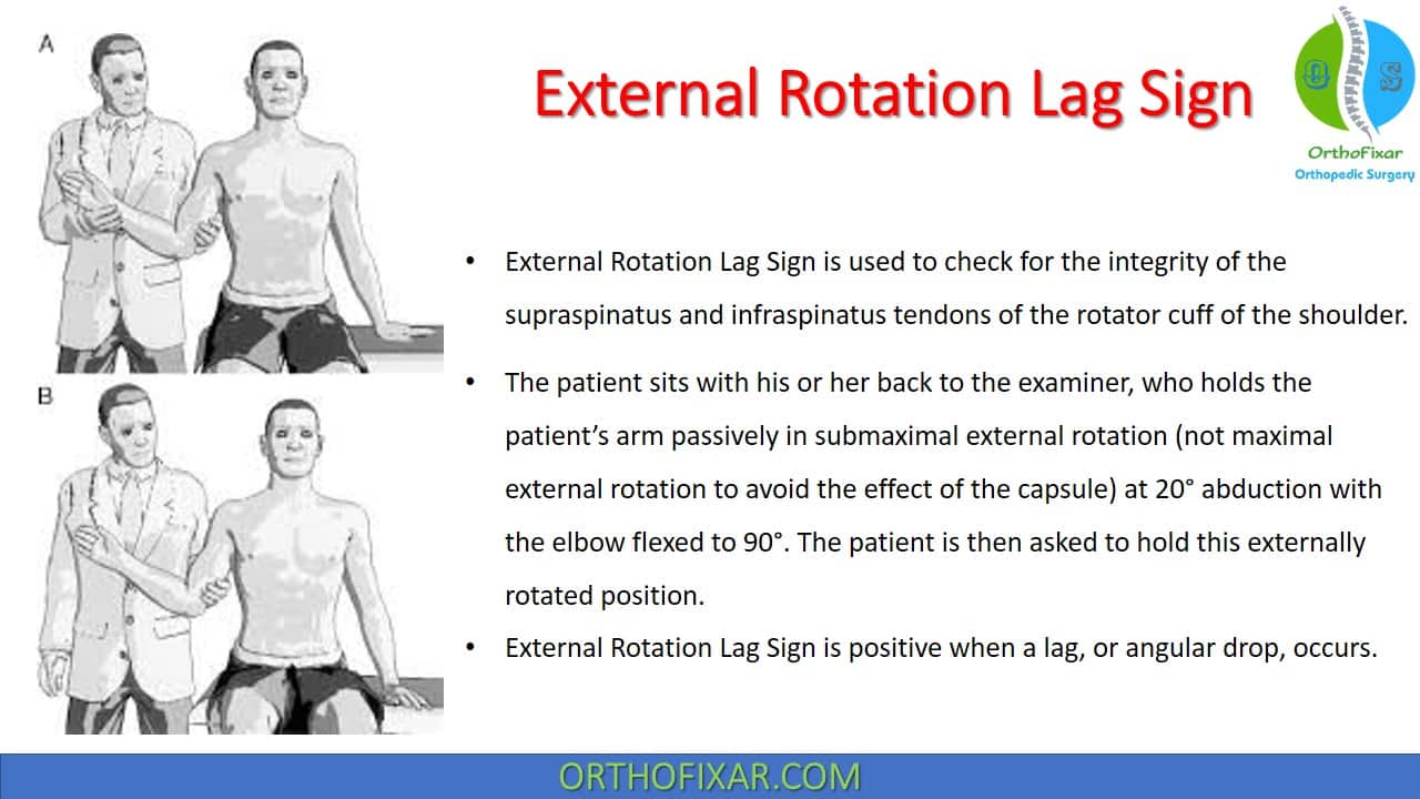  External Rotation Lag Sign 