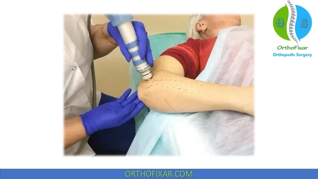 Tennis elbow Extracorporeal shock wave therapy