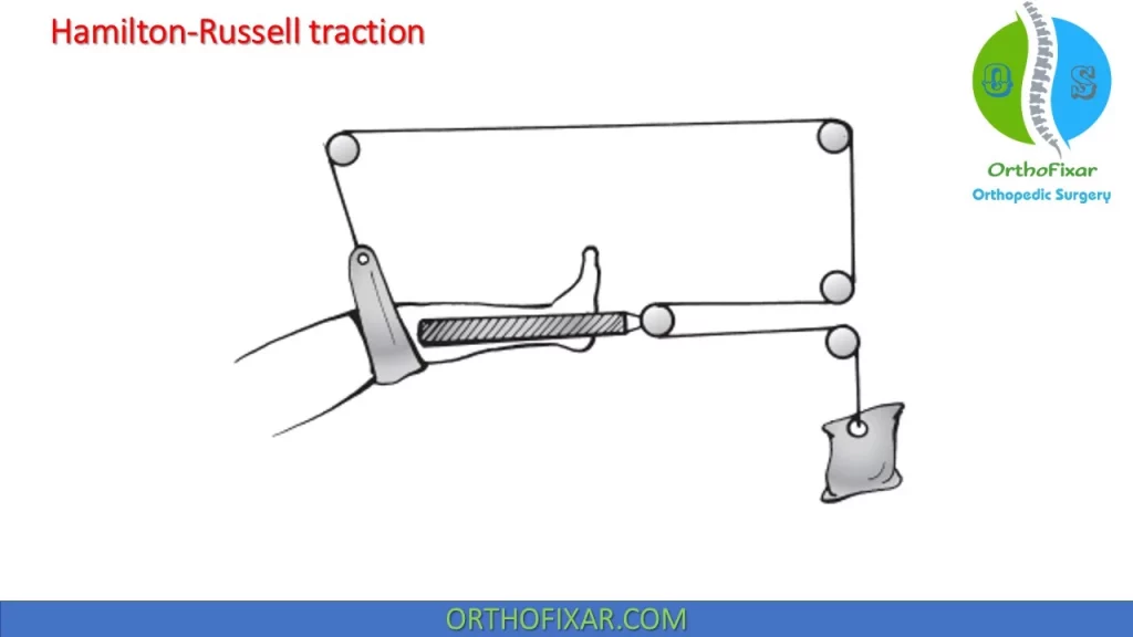 Hamilton-Russell traction