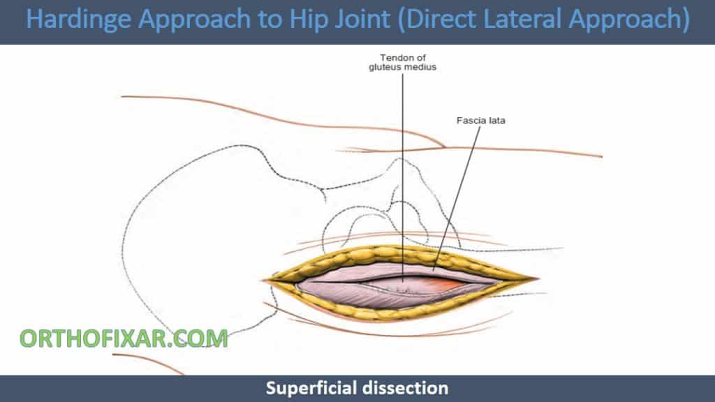 Hardinge Approach to Hip Joint (Direct Lateral Approach)