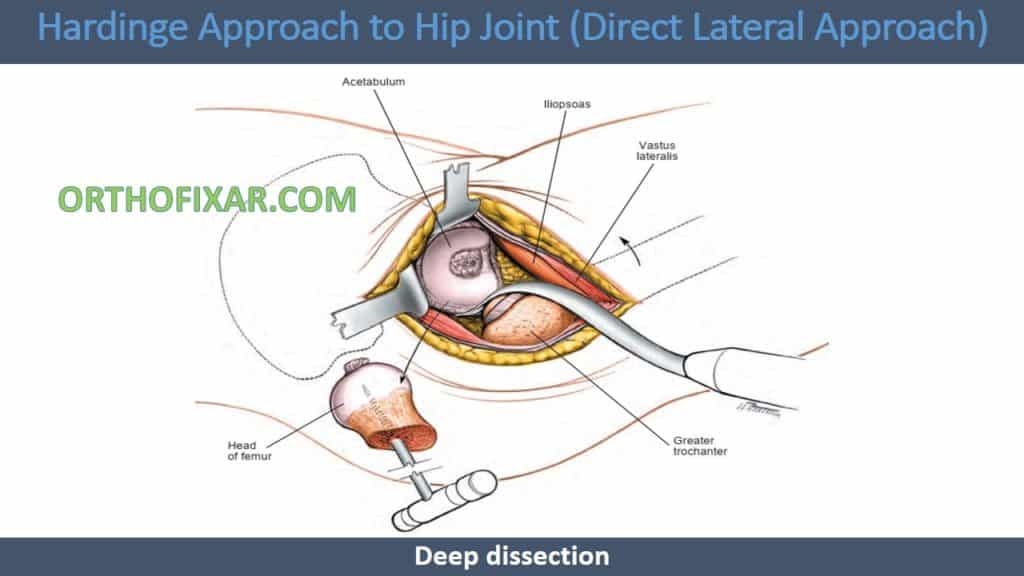 Hardinge Approach to Hip Joint (Direct Lateral Approach)