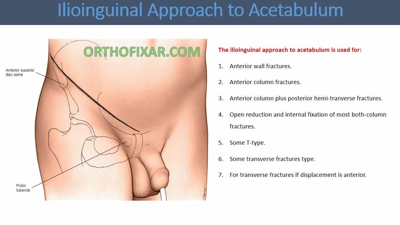 Ilioinguinal Approach to Acetabulum 