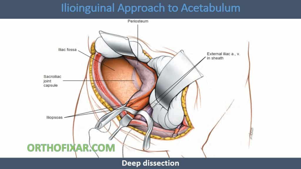 Ilioinguinal Approach to Acetabulum