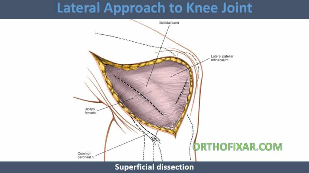 Lateral Approach to Knee Joint