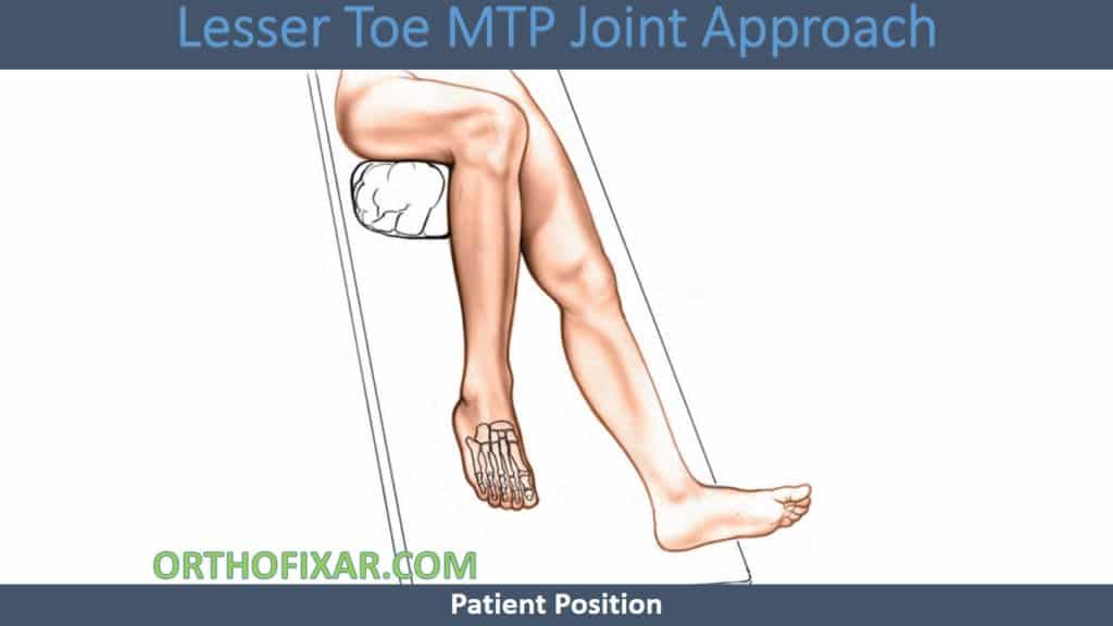 Lesser Toe MTP Joint Approach