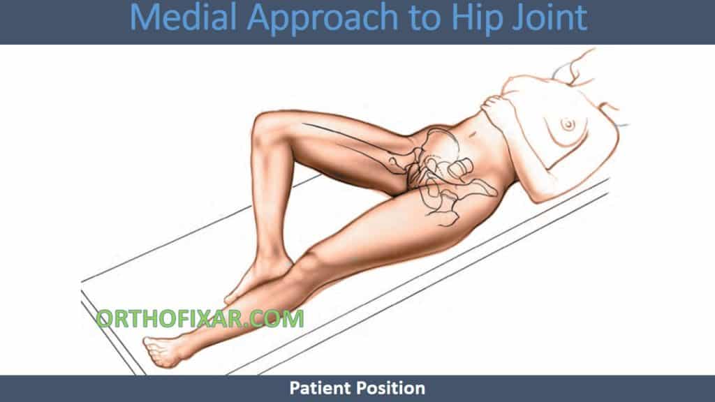 Medial Approach to Hip Joint