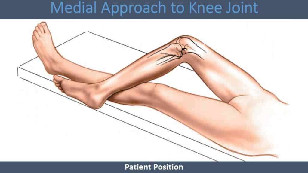 Medial Approach to Knee Joint