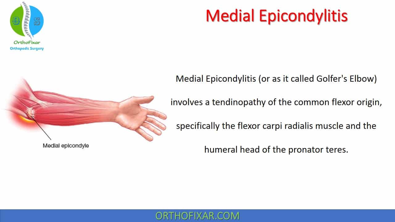 Medial Epicondylitis 