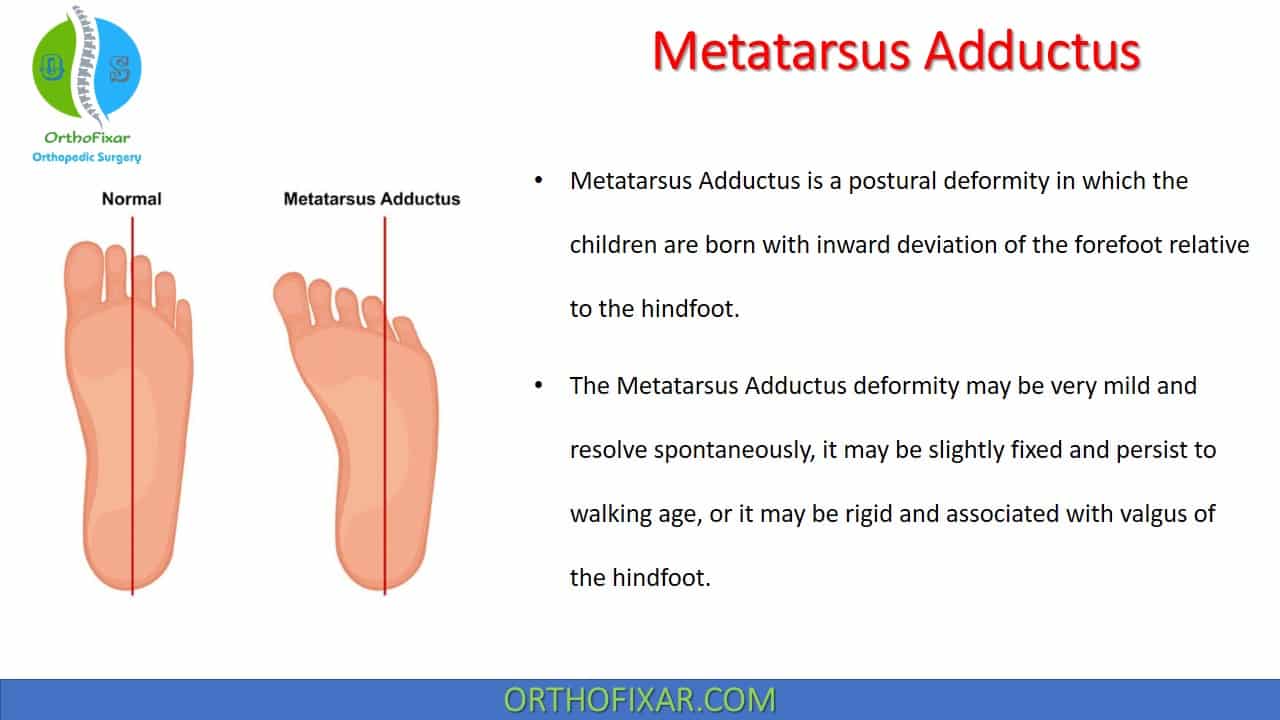  Metatarsus Adductus 