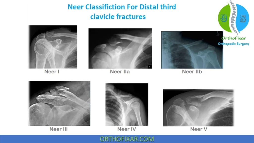 Neer classification of clavicle fracture