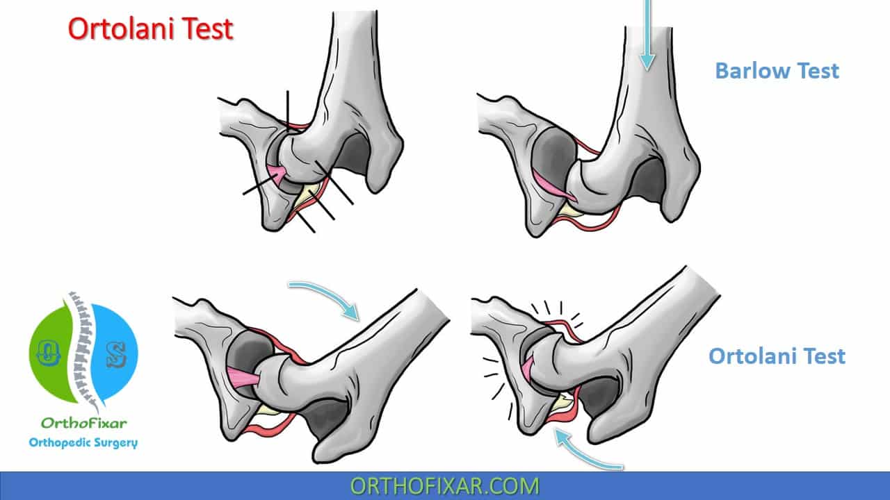 Ortolani Test Definition What For Easy Explained 2021 Orthofixar