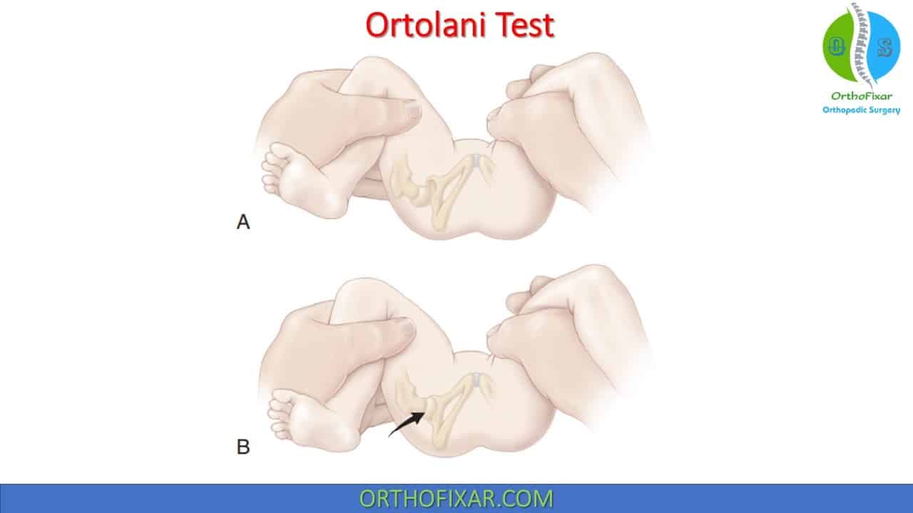  Ortolani Test 