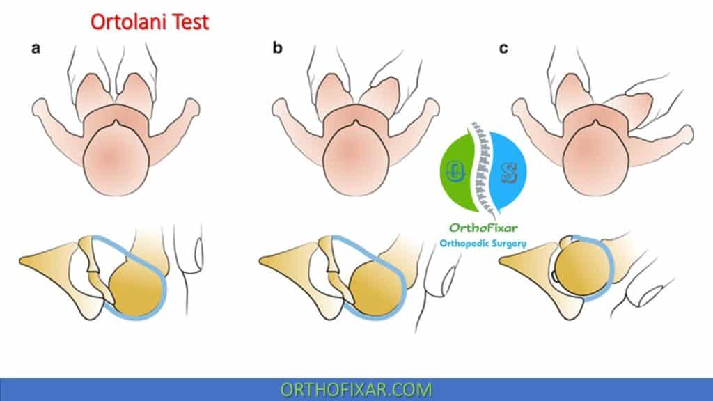 Ortolani Test