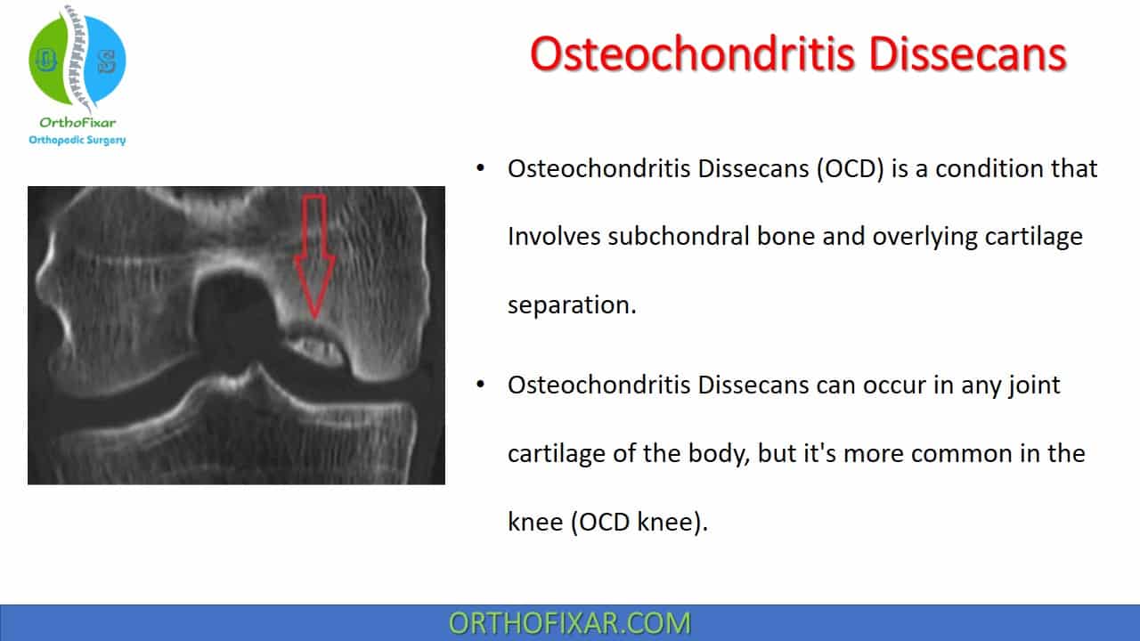  Osteochondritis Dissecans 