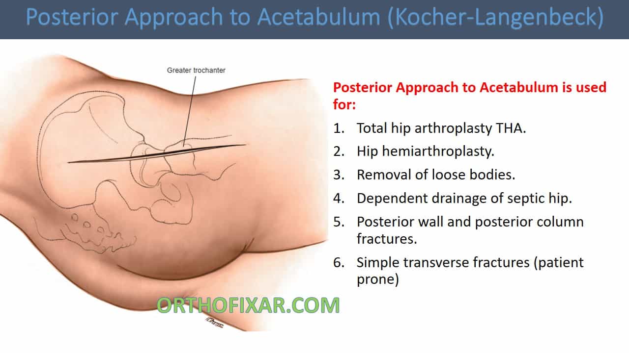  Posterior Approach to Acetabulum (Kocher-Langenbeck) 