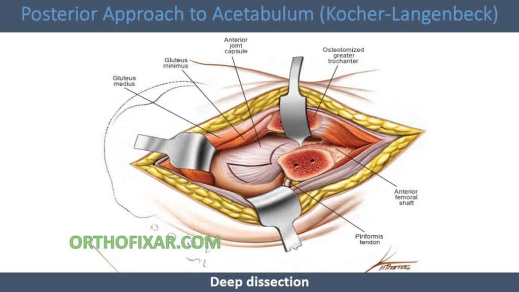 Posterior Approach to Acetabulum