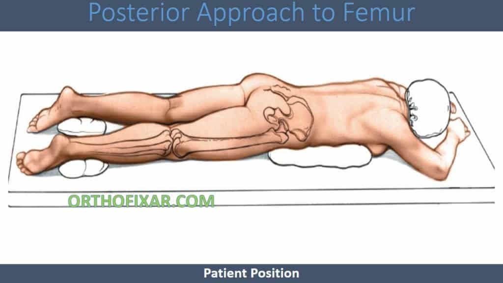 Posterior Approach to Femur