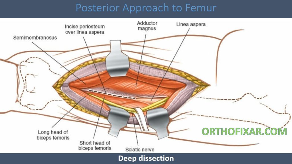 Posterior Approach to Femur