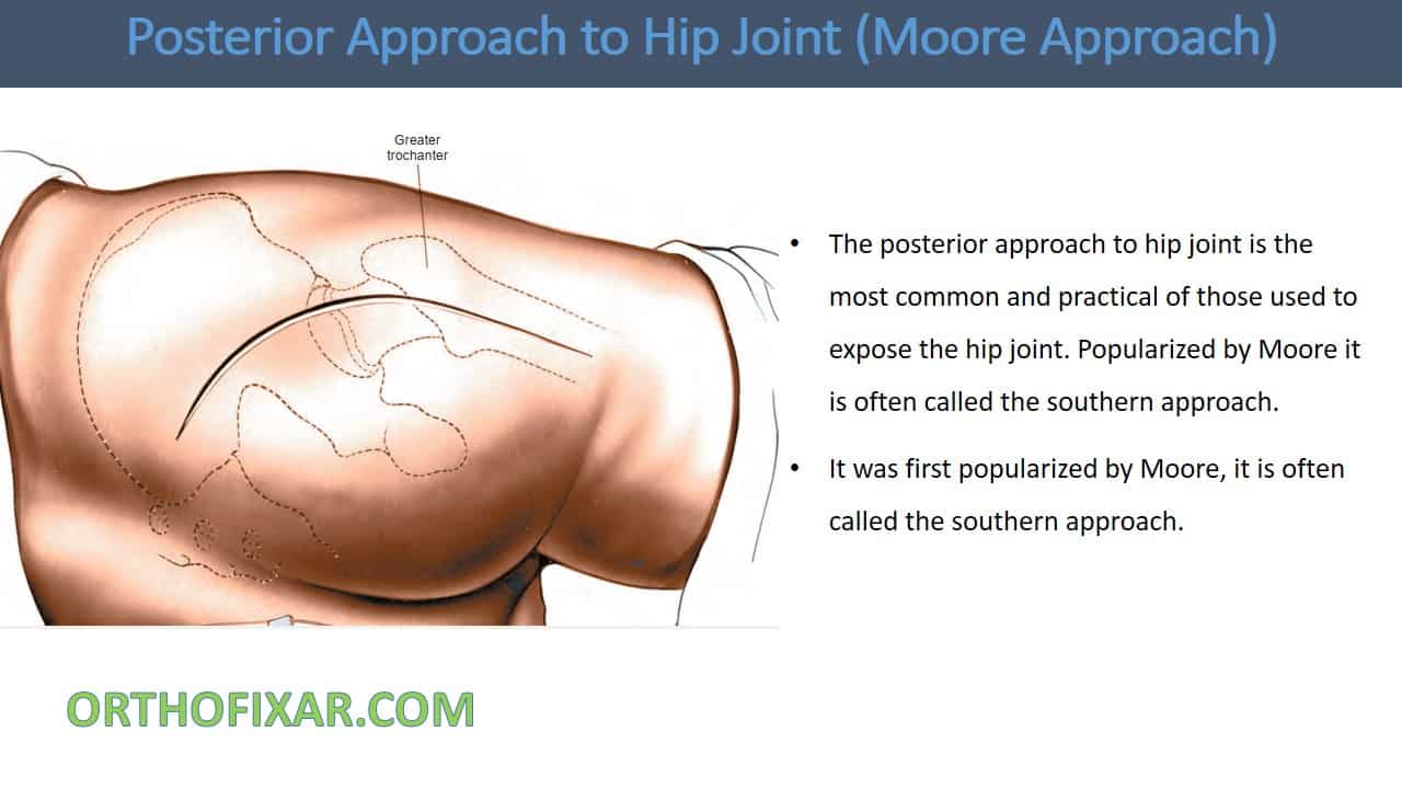  Posterior Approach to Hip 