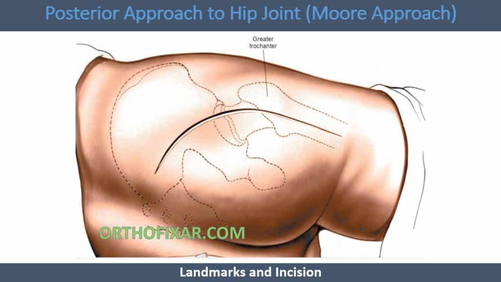 Posterior Approach to Hip Joint (Moore Approach)