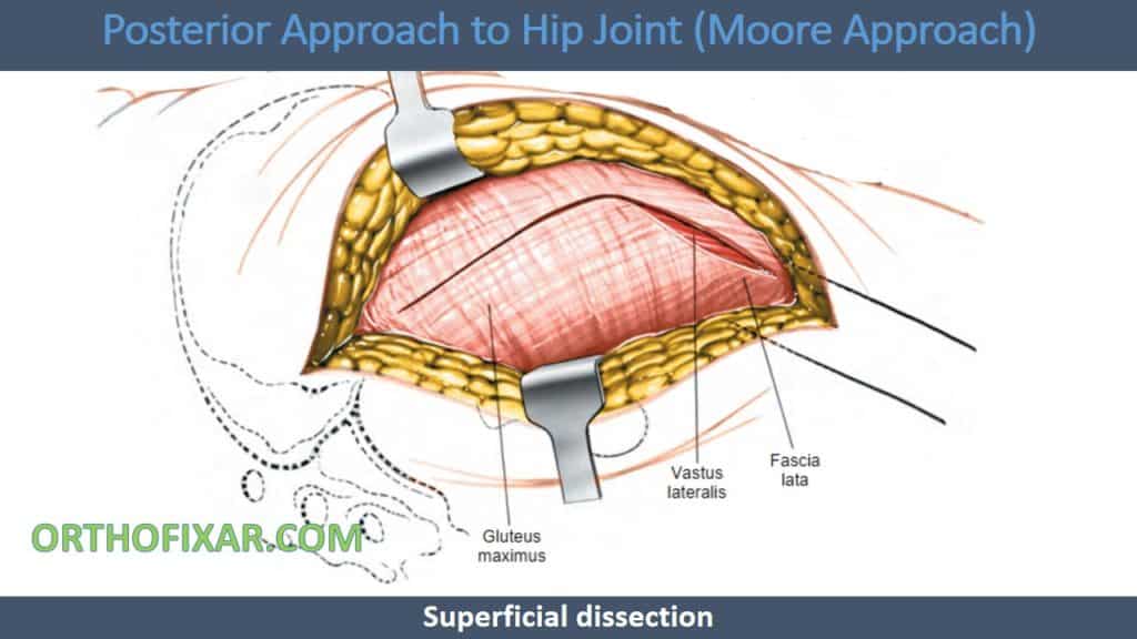 Posterior Approach to Hip Joint (Moore Approach)