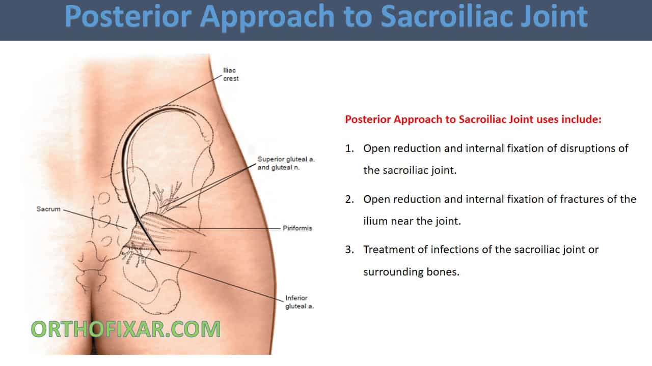  Posterior Approach to Sacroiliac Joint 