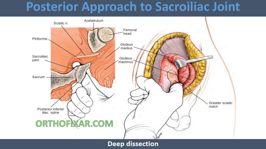 Posterior Approach to Sacroiliac Joint