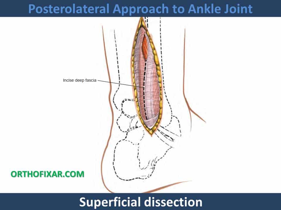 Posterolateral Approach to Ankle Joint