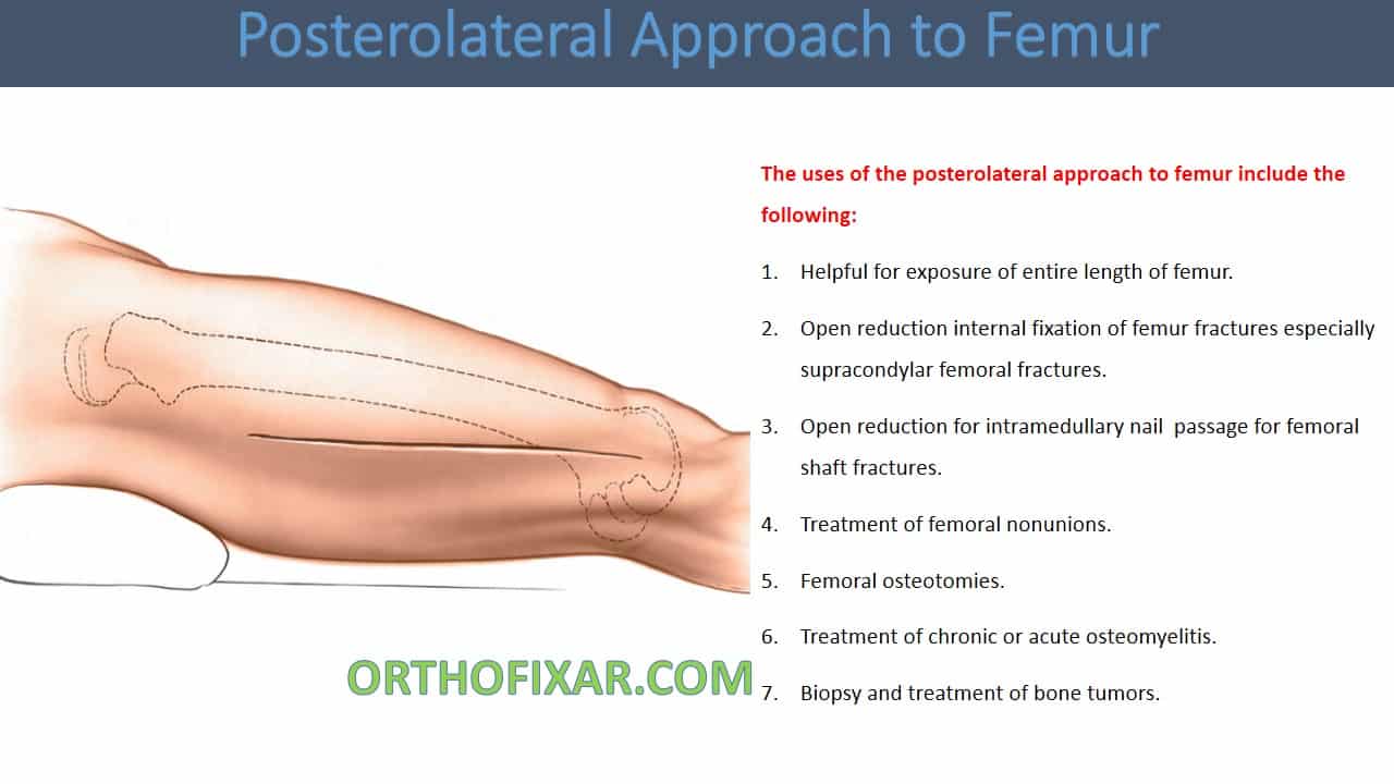  Posterolateral Approach to Femur 
