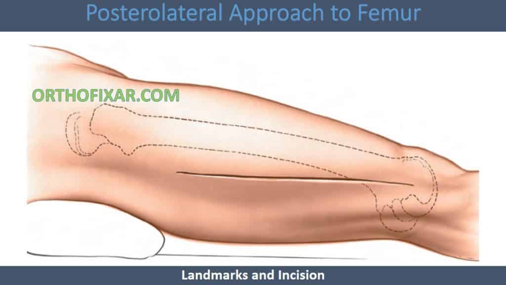 Posterolateral Approach to Femur