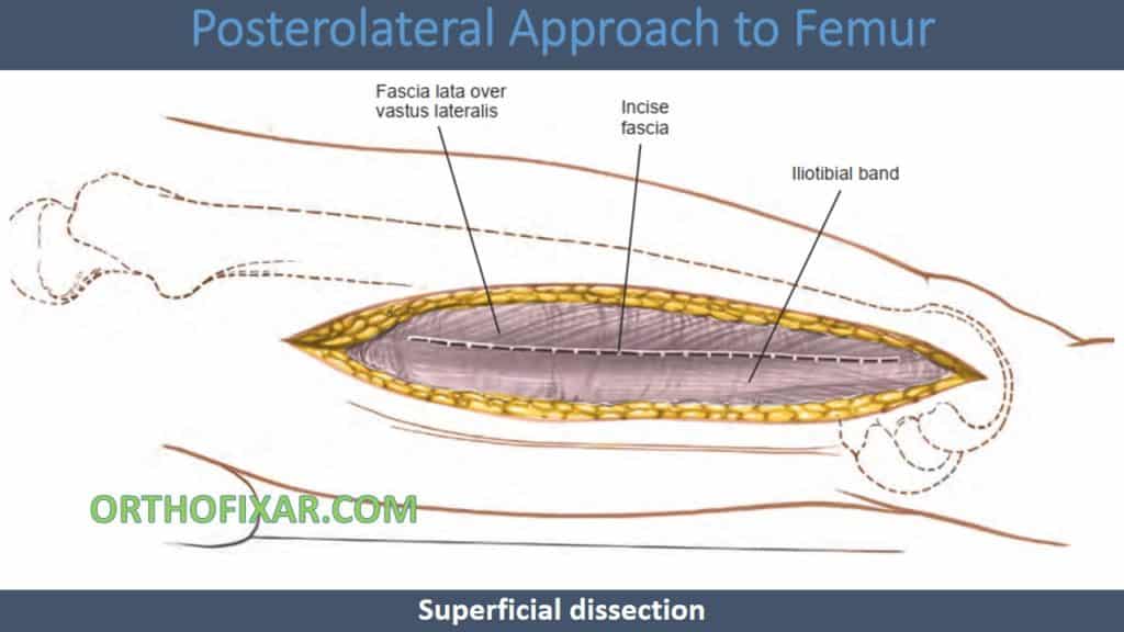 Posterolateral Approach to Femur