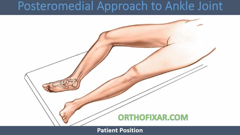 Posteromedial Approach to Ankle Joint