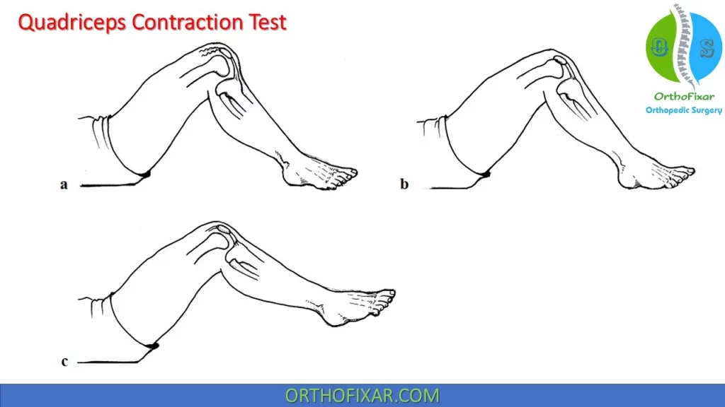 Quadriceps Contraction Test