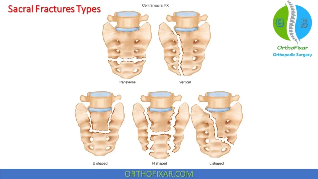 Sacral fractures types