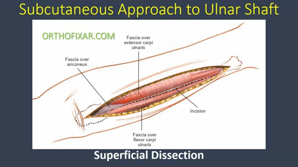Subcutaneous Approach to Ulnar Shaft
